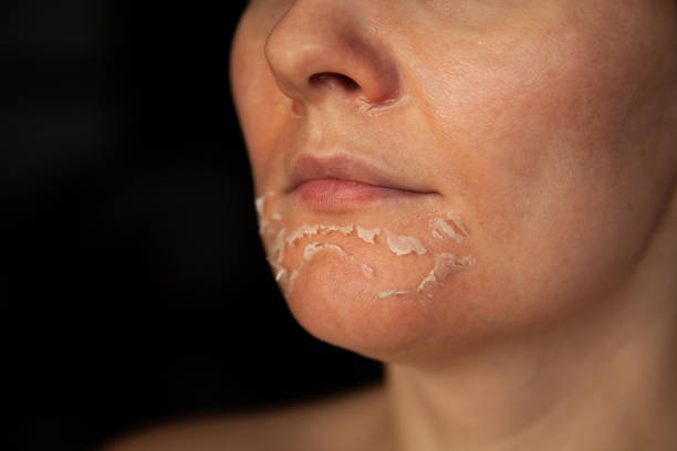 volto della donna dopo il peeling chimico. pelle traballante sul viso - scrostare foto e immagini stock