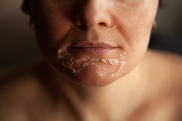 peeling de visage rétinoïque. visage de la femme après peeling chimique. peau floconneuse sur le visage - human skin dry human face peeling photos et images de collection