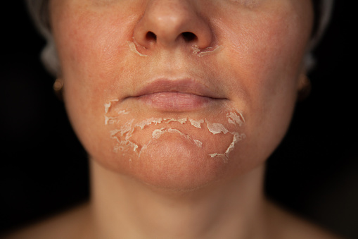 Pelar la piel en la cara. Cara de mujer después de pelado químico. Exfoliación de la piel vieja. photo