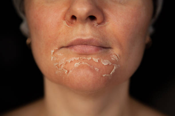Peeling skin on the face. Woman's face after chemical peeling. Exfoliation of old skin. Woman's face after chemical peeling. Peeling skin on the face. Exfoliation of old skin. Facial rejuvenation. Retinoic face peeling peel plant part stock pictures, royalty-free photos & images