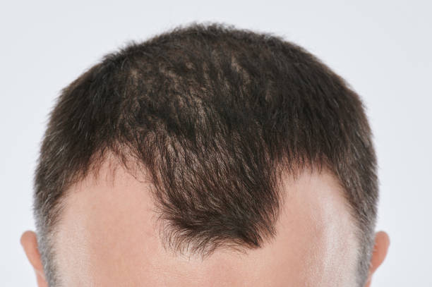 istock Damaged man hair 1192747881