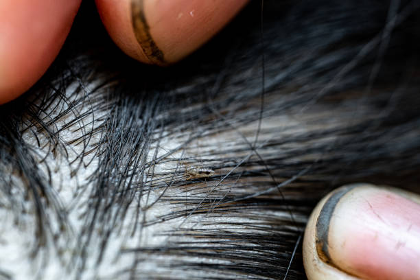 istock Louse egg on the hair causes itchy head. 1192832960