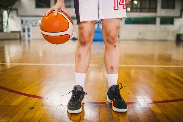Look at the legs of a girl who has basketball injuries