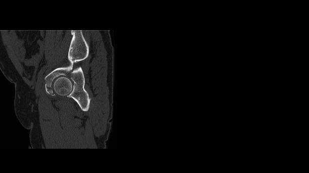 кт (компьютерная томография)радиография тазобедренного сустава показывает перелом тазобедренной кости или перелом ацетабулума (ацетабул� - insurance physical injury transportation healthcare and medicine стоковые фото и изображения