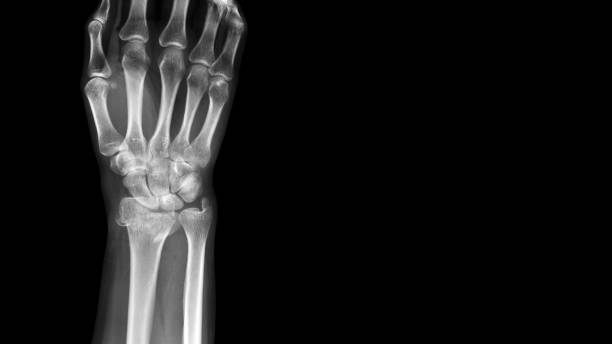 Film X ray wrist radiograph show distal forearm bone broken ( distal end radius fracture). The patient has wrist pain, swelling and deformity. Medical imaging for investigation and technology concept Film X ray  fracture radius deformed stock pictures, royalty-free photos & images