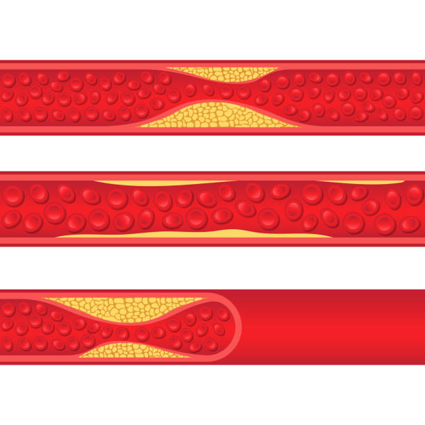 Arteriosclerosis vector design illustration isolated on white background Beautiful vector design illustration of arteriosclerosis isolated on white background clogged artery stock illustrations