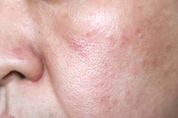 Allergy rash on the face stock photo