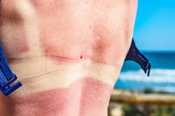 Caucasian woman back and shoulders skin hurt from sun burn. Severely burned skin, red tanned body