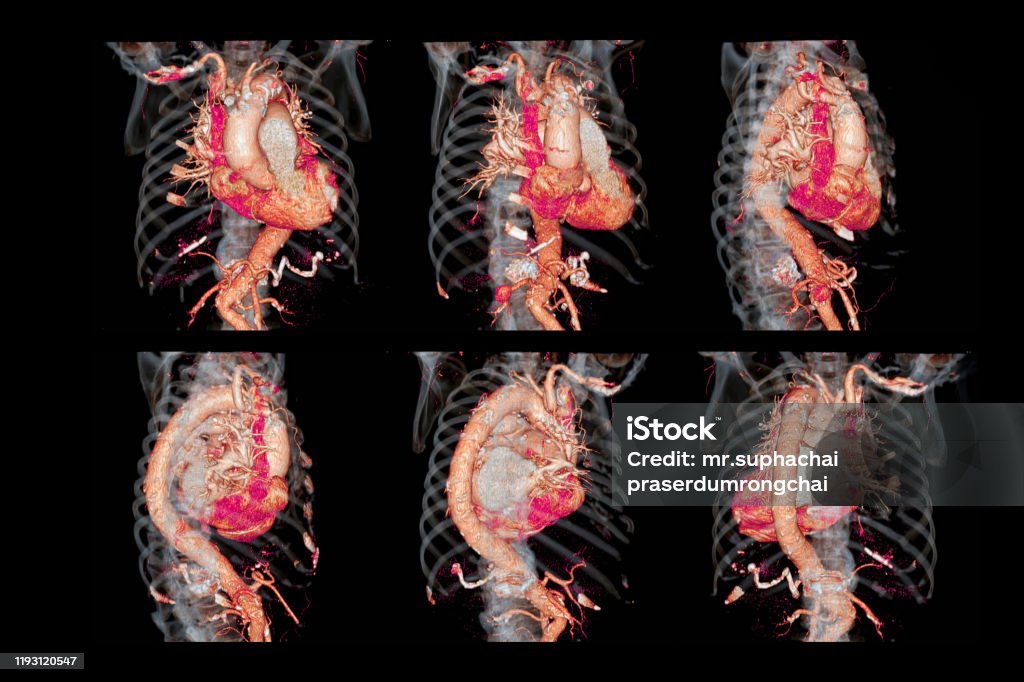 CTA thoracic aorta  3D rendering image. Collection  of CTA thoracic aorta  3D rendering image for  diagnostic abdominal aortic aneurysm or AAA and aortic dissection Aorta Stock Photo