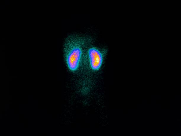 a static kidney scintigraphy (dmsa) image that shows two completely normal kidneys. the left kidney is on the left side of the colourful image and vice versa. - 4722 imagens e fotografias de stock