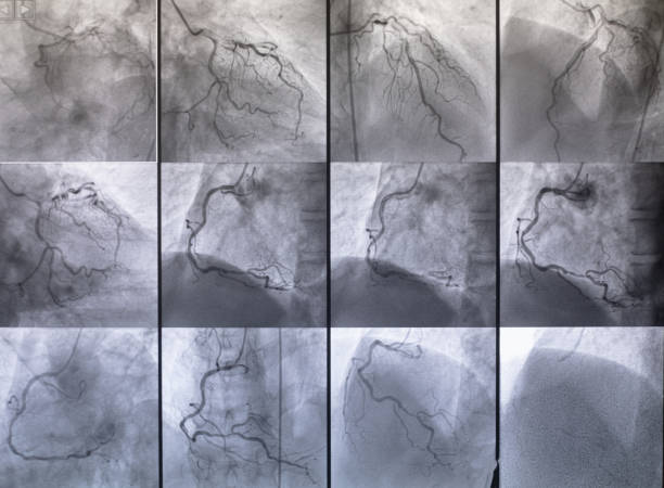 Coronary angiography , left and right coronary angiography stock photo