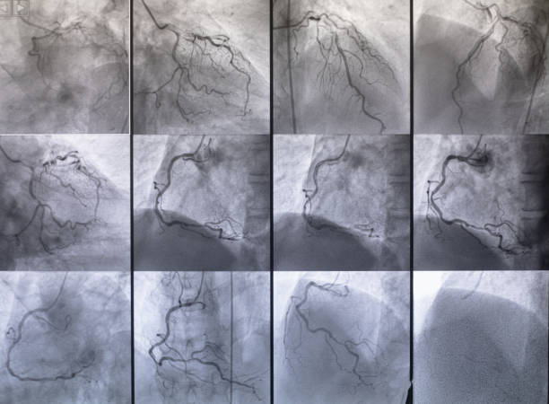 коронарная ангиография, левая и правая коронарная ангиография - pulse trace human cardiovascular system heart shape heart disease стоковые фото и изображения