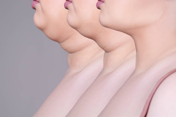 Double chin surgery in Hyderabad