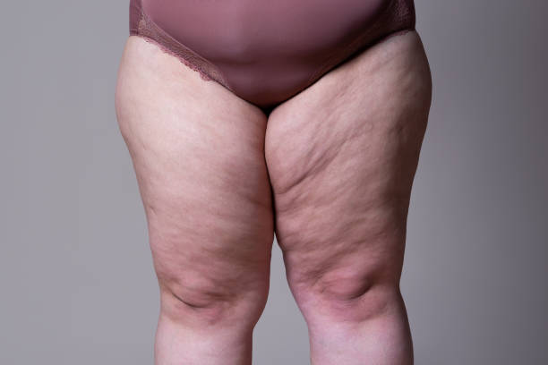 Fat female thigh on gray background Fat female thigh on gray background, plastic surgery concept human leg stock pictures, royalty-free photos & images