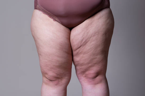 Fat female thigh on gray background Fat female thigh on gray background, plastic surgery concept big legs stock pictures, royalty-free photos & images