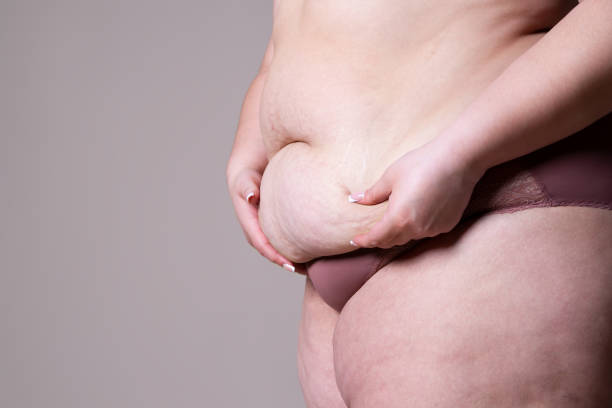 tummy tuck, schlaffe haut auf einem fetten bauch, plastische chirurgie konzept - torso female hip human skin stock-fotos und bilder