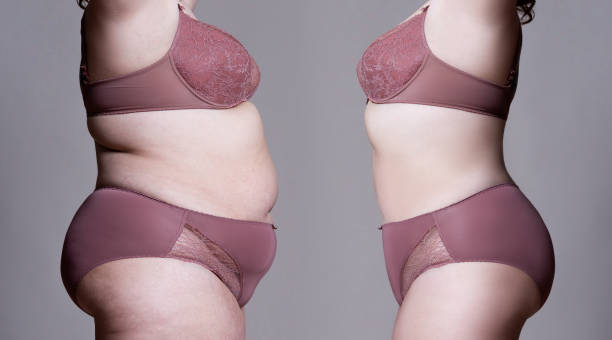 Fat woman's body before and after weight loss Fat woman's body before and after weight loss on gray background before and after weight loss stock pictures, royalty-free photos & images