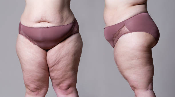 istock Fat female thigh on gray background 1193364714