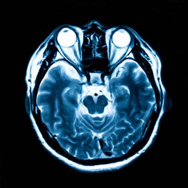 tomografía por rmis de la cabeza humana - mri scan human nervous system brain medical scan fotografías e imágenes de stock