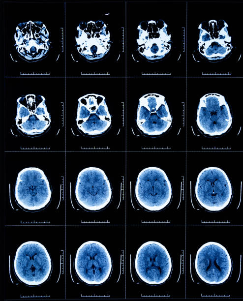 tomografía por rmis de la cabeza humana - mri scan human nervous system brain medical scan fotografías e imágenes de stock