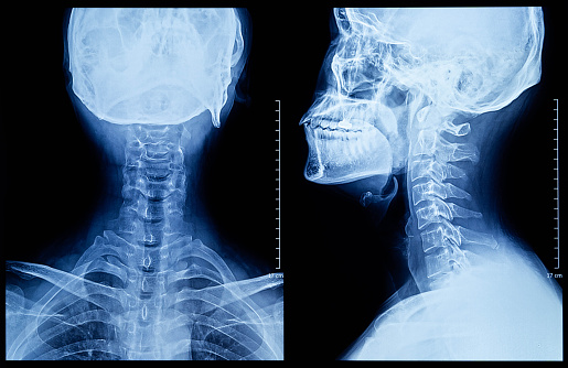 Película de rayos X del cuello humano photo
