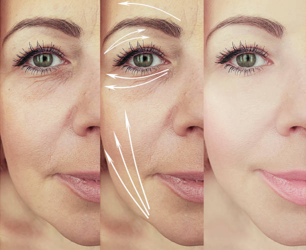 istock woman face wrinkles before and after treatment 1193700149