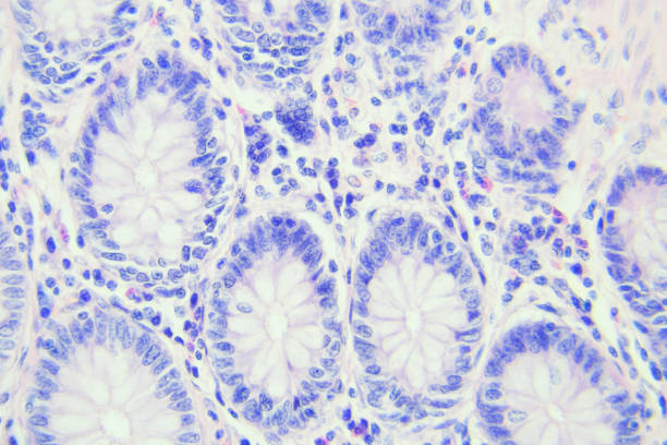 photographie microscopique du cancer du côlon, grossissement x400 - microscope view photos et images de collection