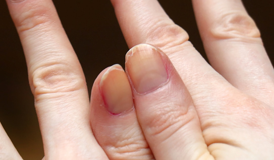 Cracked fingernails with brittle splitting and peeling nails