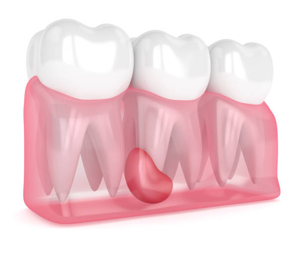 istock 3d render of teeth in gums with cyst 1193841050