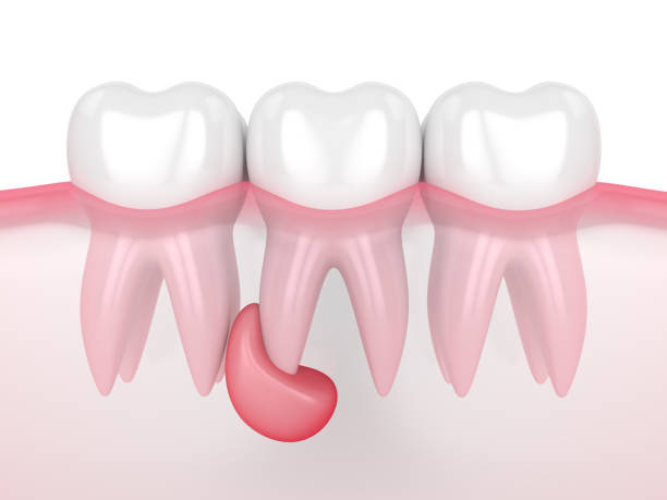 rendu 3d des dents dans des gencives avec le kyste - bacterium biology flowing vascular photos et images de collection