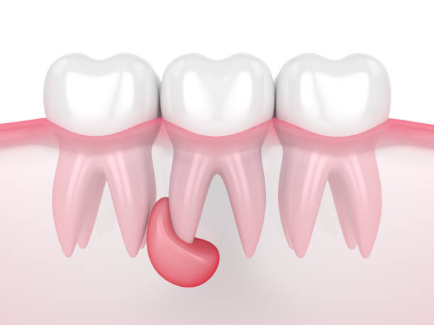 istock 3d render of teeth in gums with cyst 1193841061