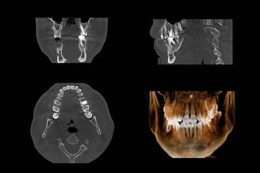 Set of MRI scanner slices of dental part of adult human male scull with multiple problems on white background.