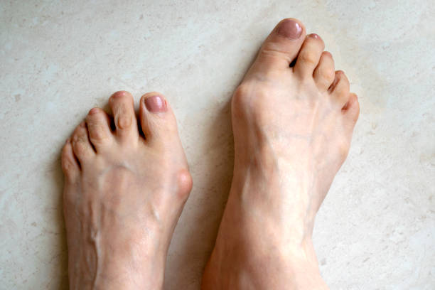 hallux valgus, gros os anormaux des pieds. - misalignment photos et images de collection