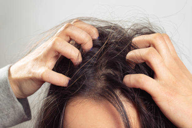 Closeup woman hand itchy scalp, Hair care concept a young woman scratches her scalp and hair with her fingers. Hair health concept, scalp and hair care dandruff stock pictures, royalty-free photos & images