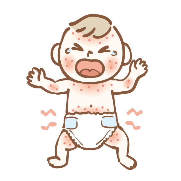 Illustration of a baby with infant eczema Illustration of a baby with infant eczema ugly people crying stock illustrations