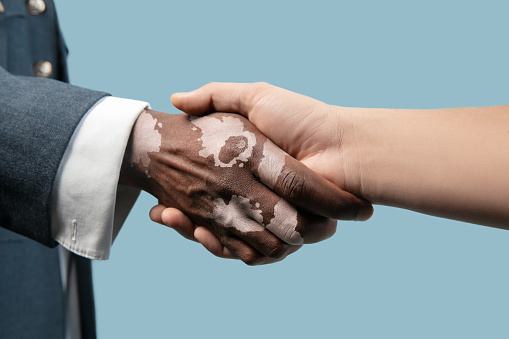 Close up of male hands with vitiligo pigments isolated on blue studio background. Wearing office attire, workwear. Special skin. Greeting somebody. Business, finance, advertising concept. Copyspace.
