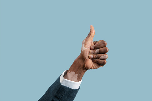 Close up of male hands with vitiligo pigments isolated on blue studio background. Wearing office attire, workwear. Special skin. Showing thumb up. Business, finance, advertising concept. Copyspace.