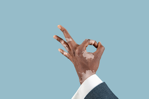 Close up of male hands with vitiligo pigments isolated on blue studio background. Wearing office attire, workwear. Special skin. Showing nice. Business, finance, advertising concept. Copyspace.