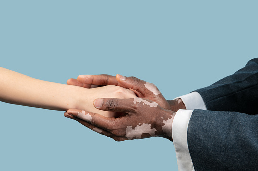 Close up of male hands with vitiligo pigments isolated on blue studio background. Wearing office attire, workwear. Special skin. Careful holding hand. Business, finance, ad concept. Copyspace.