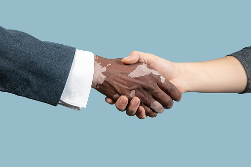 Close up of male hands with vitiligo pigments isolated on blue studio background. Wearing office attire, workwear. Special skin. Greeting somebody. Business, finance, advertising concept. Copyspace.