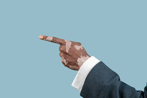 Close up of male hands with vitiligo pigments isolated on blue studio background. Wearing office attire, workwear. Special skin. Pointing on. Business, finance, advertising concept. Copyspace.