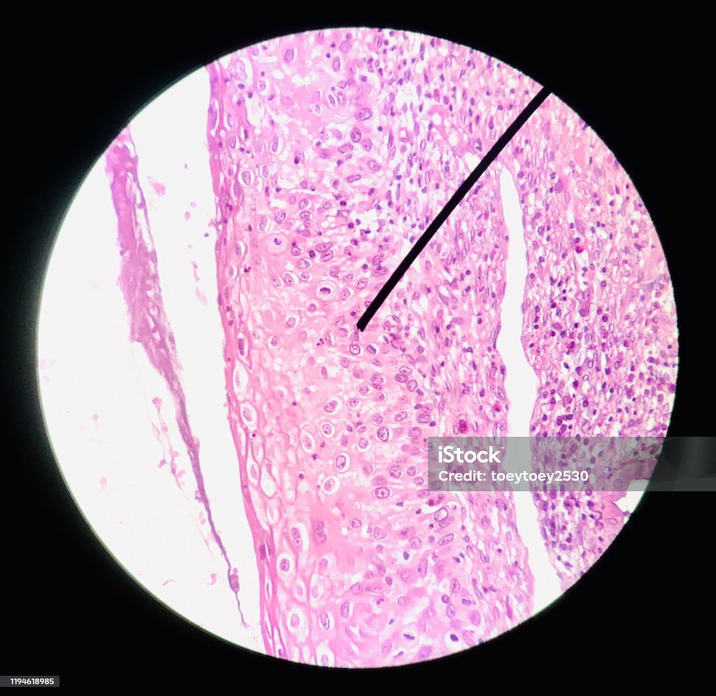 Cells in reproductive female cytology and histology concept medical scinece. Carcinoma Stock Photo