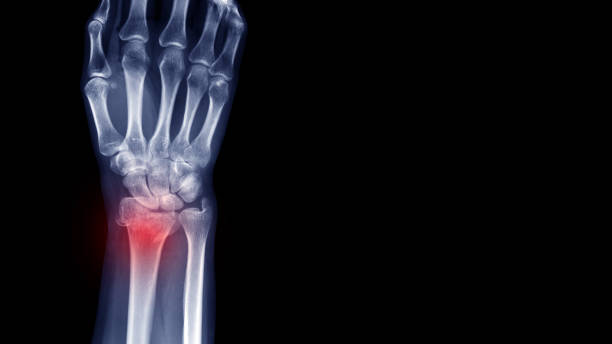 필름 x 선 손목 방사선 사진은 교통 사고에서 부러진 팔뚝 뼈의 낮은 끝을 보여줍니다 (말단 끝 반경 골절). 깨진 사이트와 고통스러운 부위에 강조 표시하십시오.  의료 영상 및 기술 개념 - orthopedic equipment osteoporosis x ray human spine 뉴스 사진 이미지