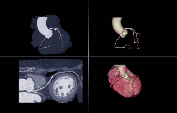 istock CTA Coronary artery  3D rendering image or coronary tree with Curve MPR of LAD view  for diagnosis of vessel coronary artery stenosis . 1194696503