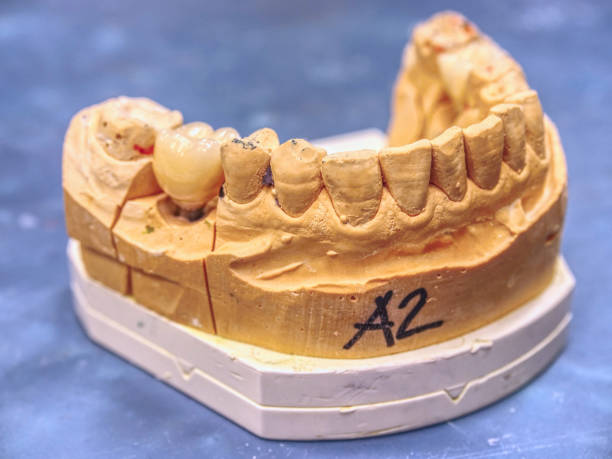 ceramic and zirconium crowns of human tooth on a model - cast in stone imagens e fotografias de stock