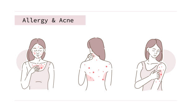 ilustrações de stock, clip art, desenhos animados e ícones de allergy and acne - body woman back