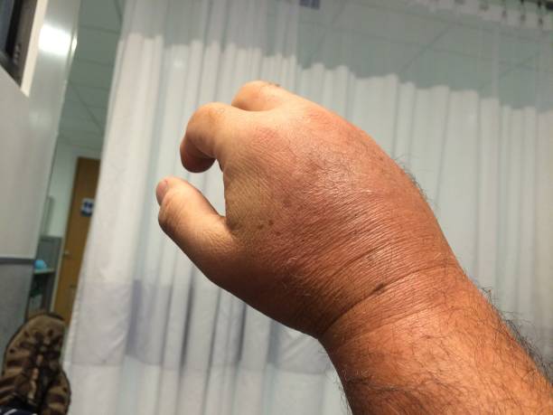 Swollen hand in emergency room