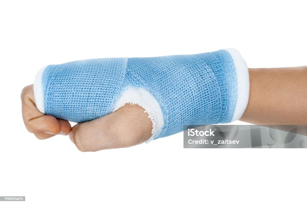 Hand in Cast on White Background Stock Image - Image of fiberglass