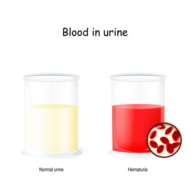 illustrations, cliparts, dessins animés et icônes de urine normale et sanglante. deux béchers avec de l'urine. l'hématurie est la présence de globules rouges dans l'urine (causant une coloration rouge). - causing