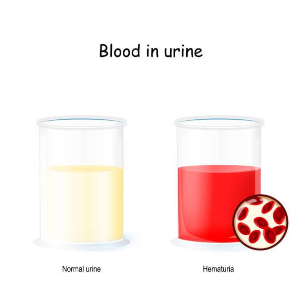 정상 및 피 묻은 소변. 소변을 가진 2개의 비커. 혈뇨는 소변에 적혈구의 존재 (붉은 색을 일으키는 원인이 됩니다). - glomerulus stock illustrations